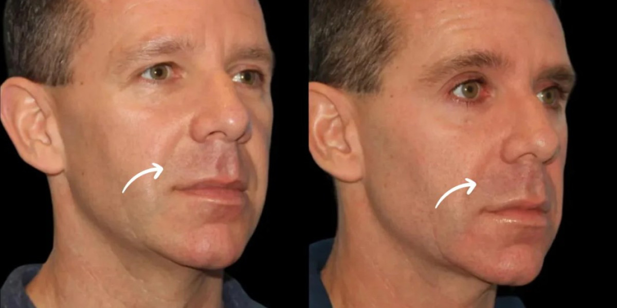 Get Red Carpet Ready with Sculptra Fillers Treatments in Dubai