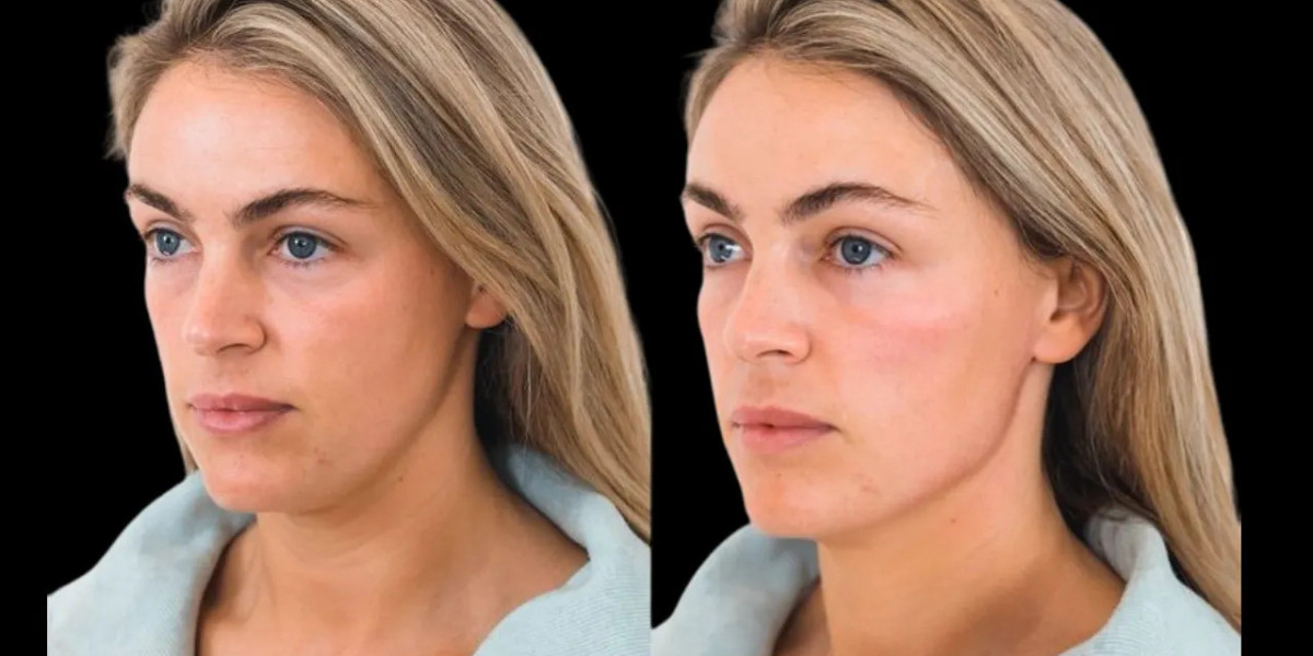 What’s the Ideal Cheek Fillers Treatment in Dubai Density for Natural Looking Results?