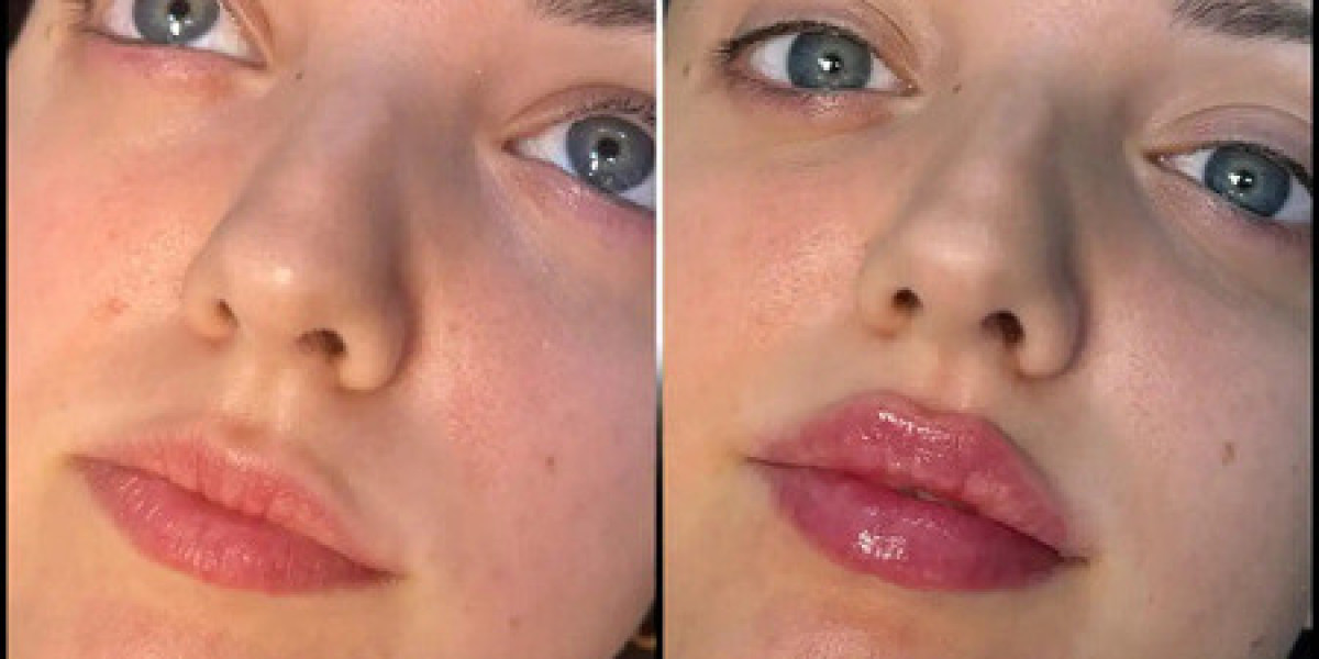 Best Doctors in dubai for Fillers with Proven Track Records