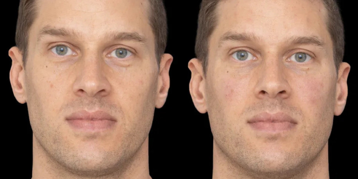How Safe is Under Eye Fillers Treatment in Dubai?