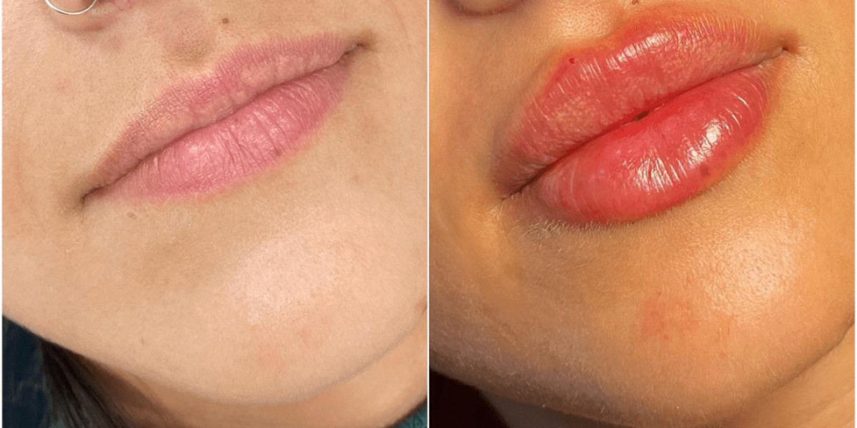 Juvederm and Non-Surgical Facelifts: How the Best Plastic Surgeons in Dubai Use Fillers to Lift and Tighten Skin