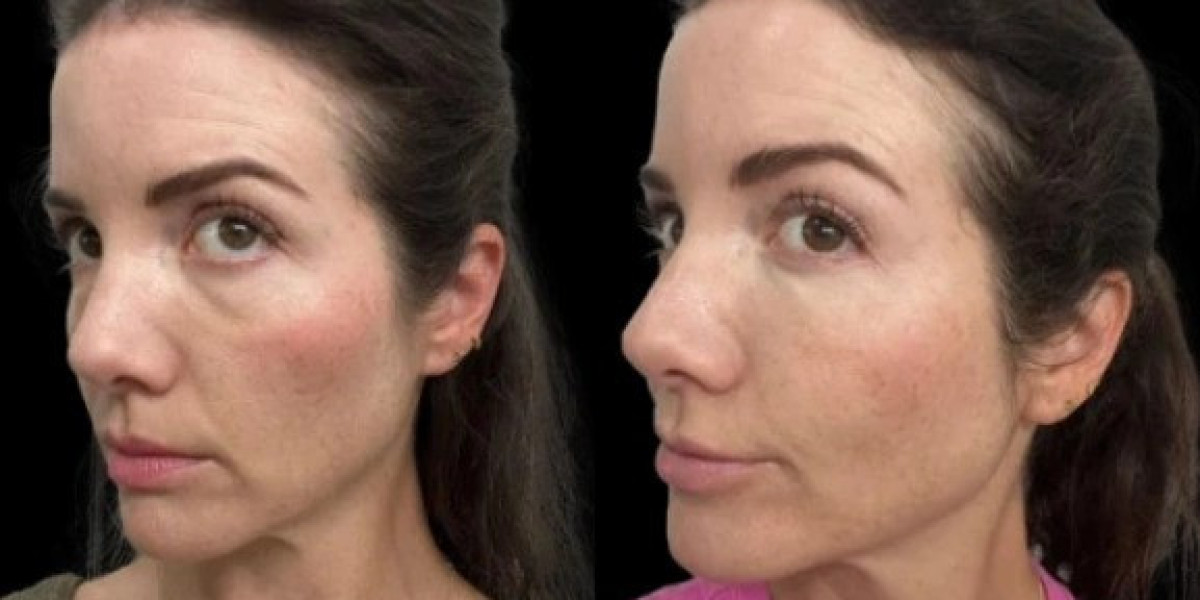 Best Plastic Surgeons in Dubai Reveal Top Dark Circles Treatment