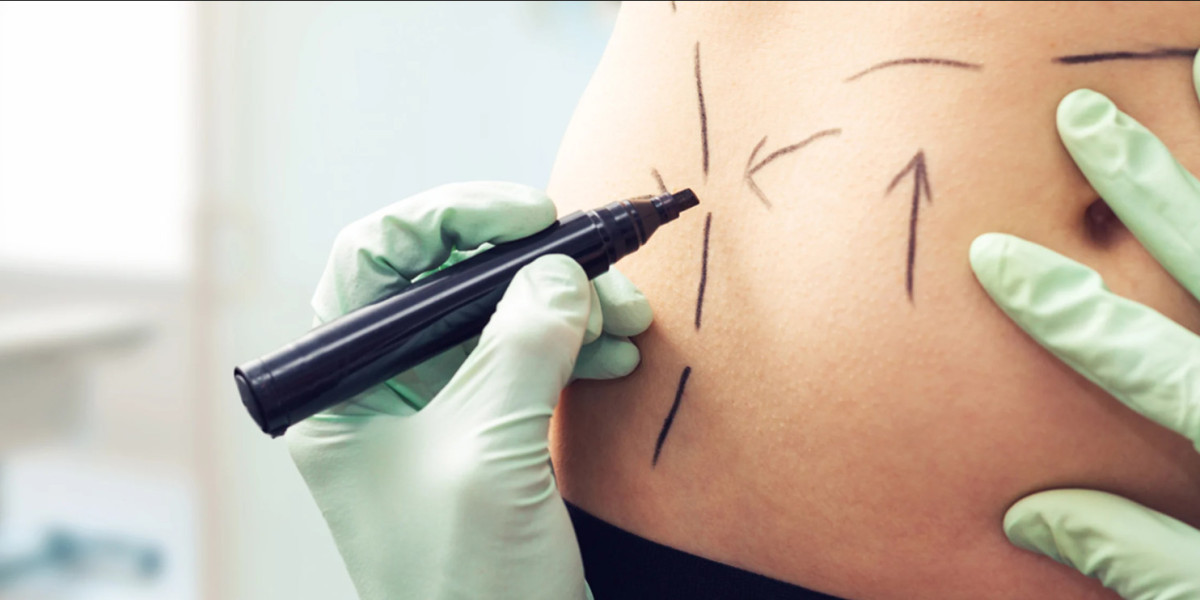 Body Contour Success with Best Liposuction Surgeon in Dubai
