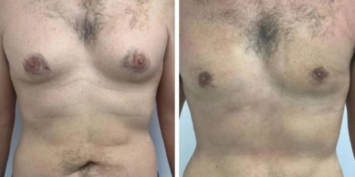 Enhancing Chest Definition After Gynecomastia in Dubai