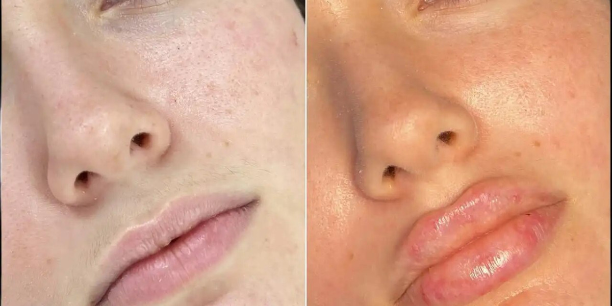 Best Plastic Surgeons in dubai Share Fillers Before and Afters