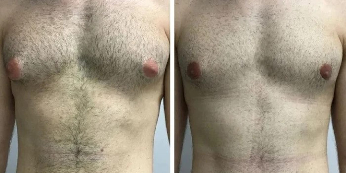 Is It Worth It? Reviews of the Best Gynecomastia Surgeon in Dubai