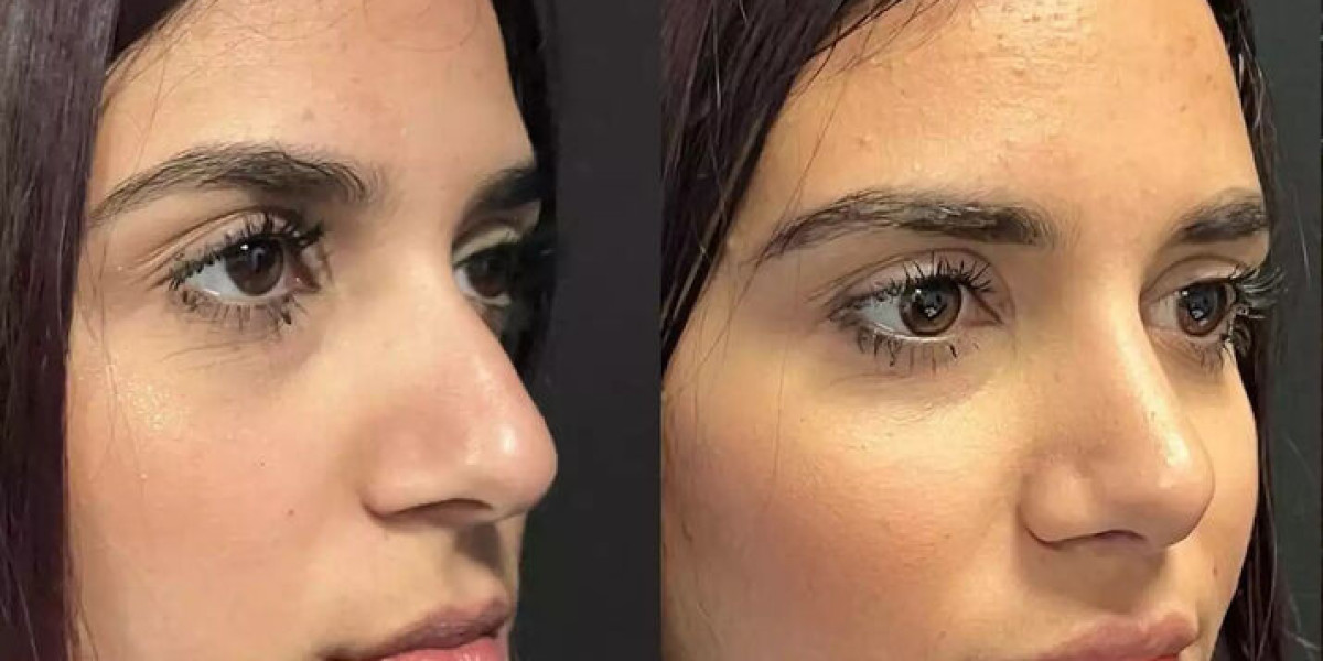 Navigating Nose Deviated Septum Surgery in Dubai