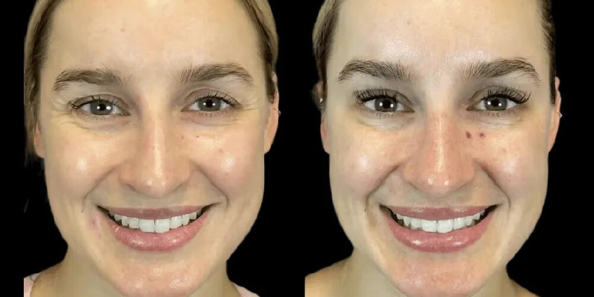 The Best Doctors in dubai on Botox Safety: What You Should Always Ask