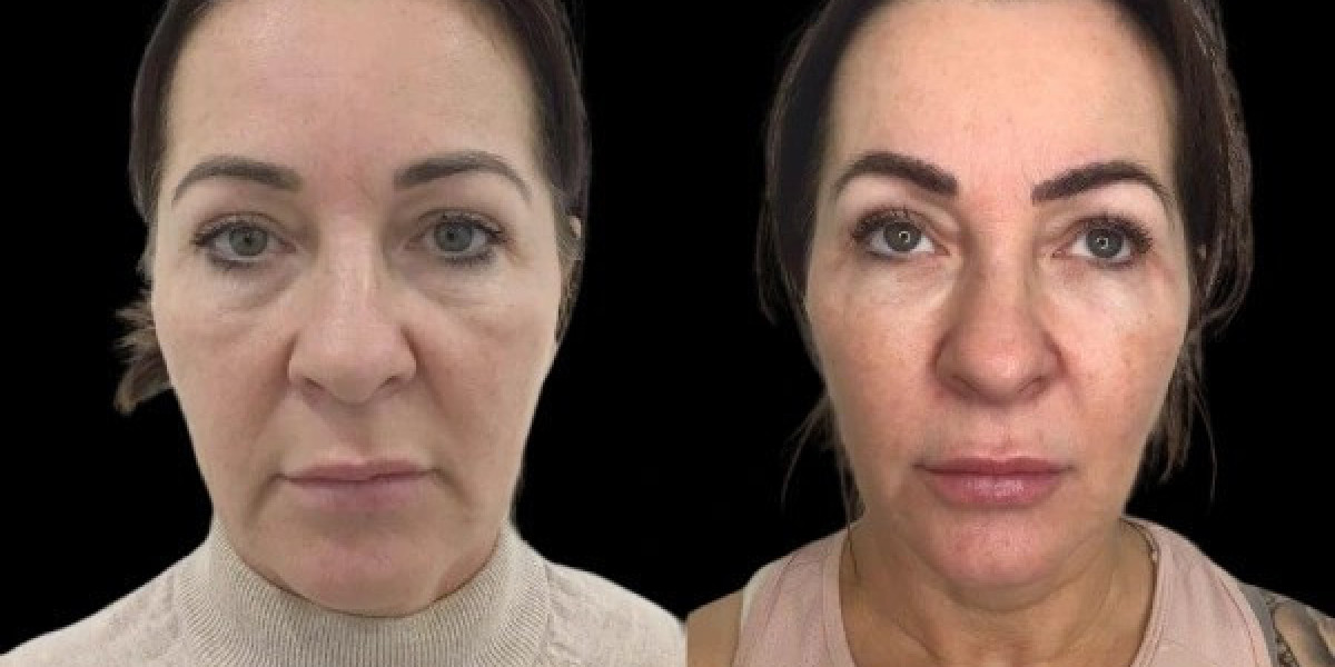 Profhilo Skin Rejuvenation by Best Plastic Surgeons in Dubai