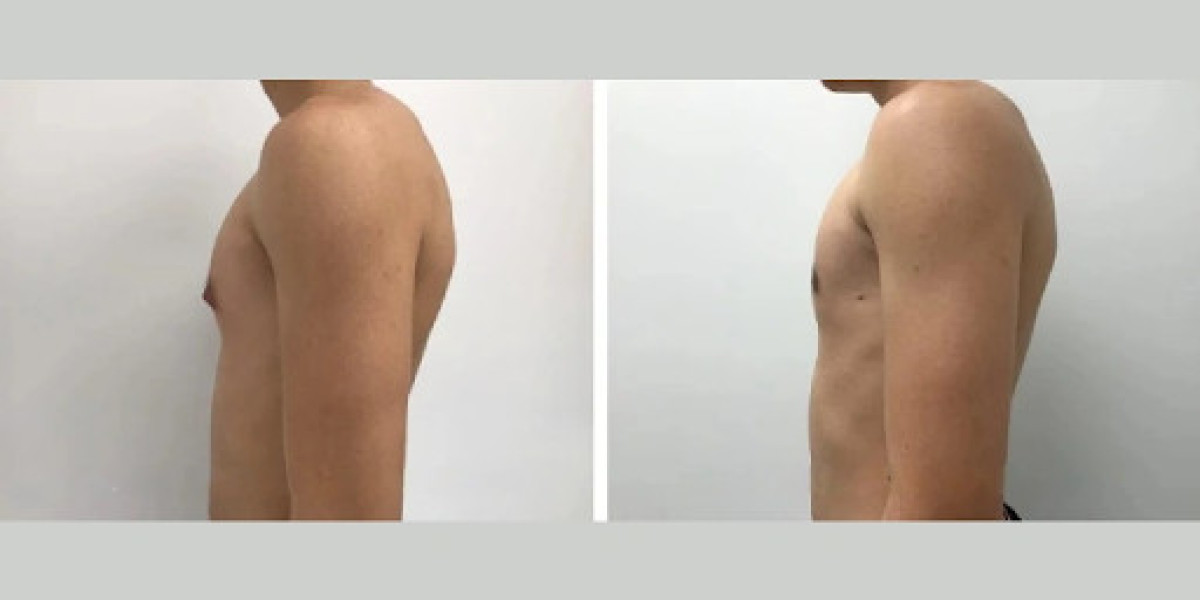 The Psychological Benefits of Gynecomastia Surgery in Dubai