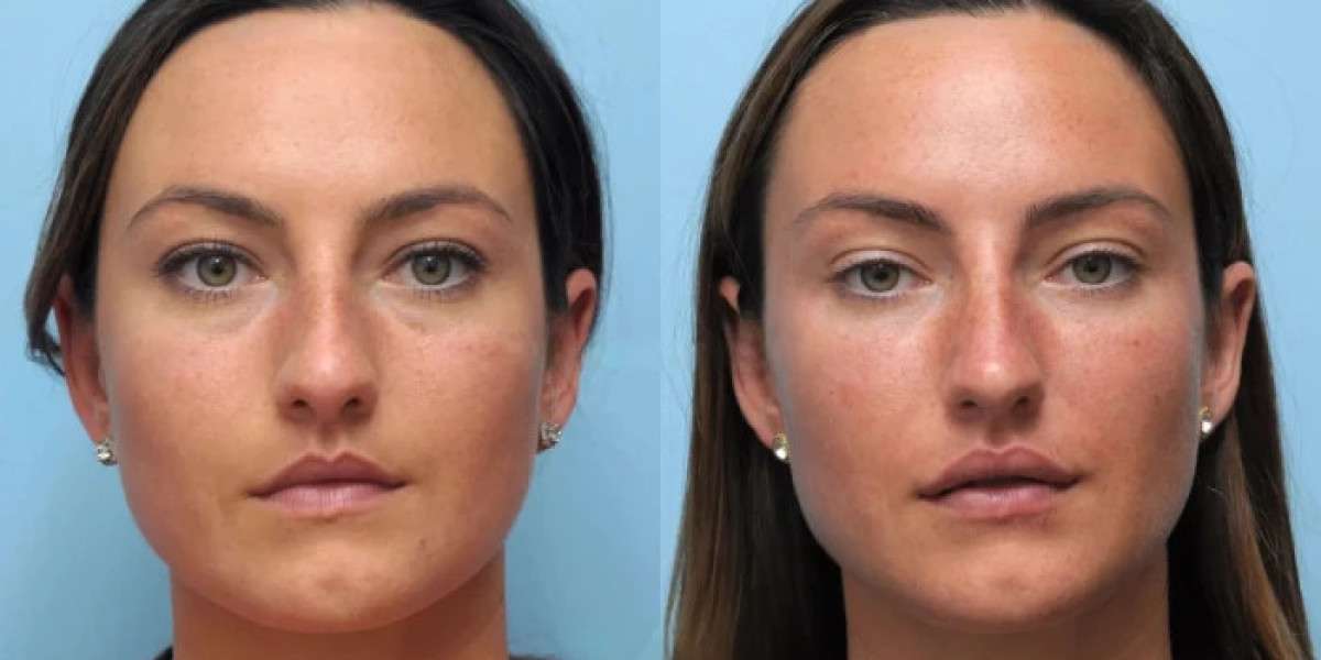 A Complete Guide to Thread Lift Treatment in Dubai