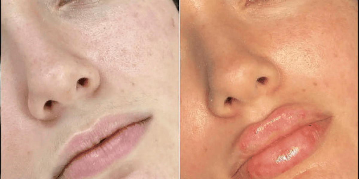 Facial Transformation with the Best Aesthetic Clinics in Dubai for Fillers