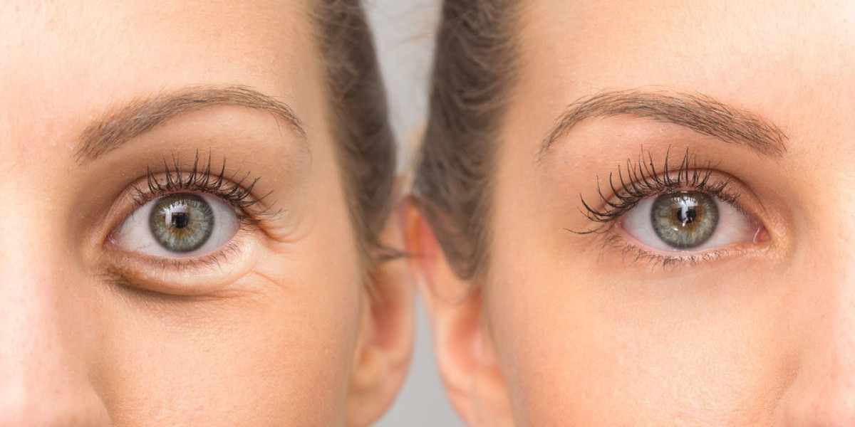 What to Expect Before and After Eyelid Bag Surgery in Dubai