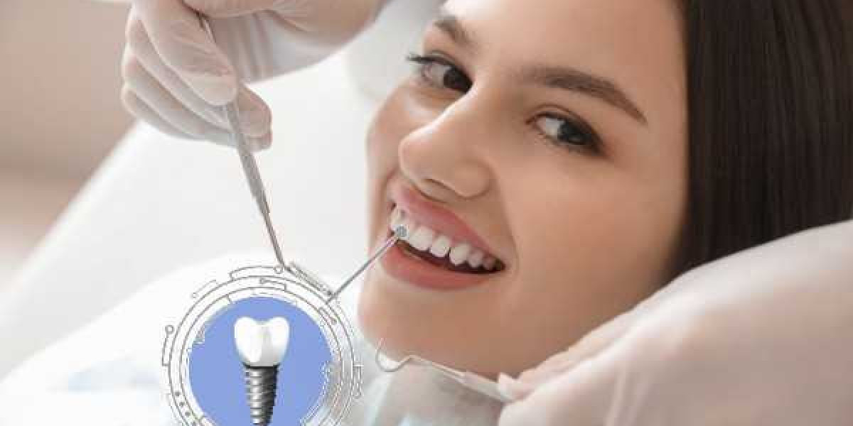 Teeth-in-a-Day: Fast Dental Implants Explained